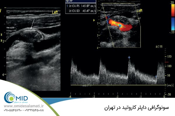 سونوگرافی داپلر کاروتید در تهران