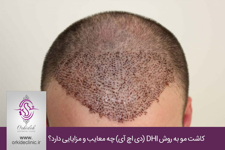 کاشت مو به روش DHI