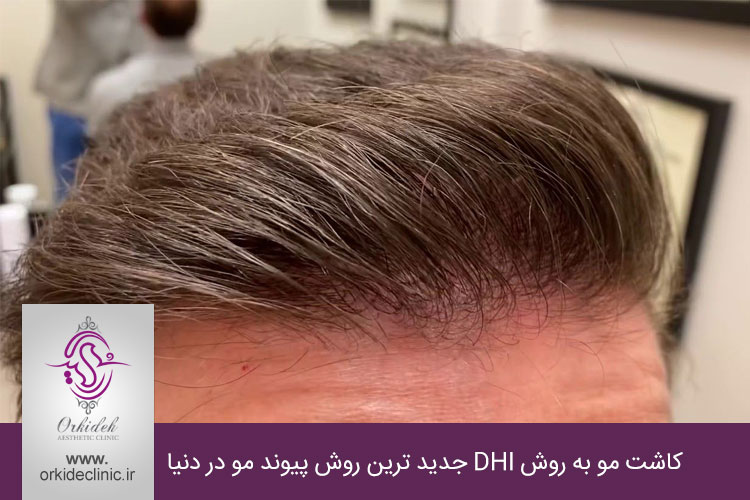 کاشت مو به روش DHI جدید ترین روش پیوند مو در دنیا