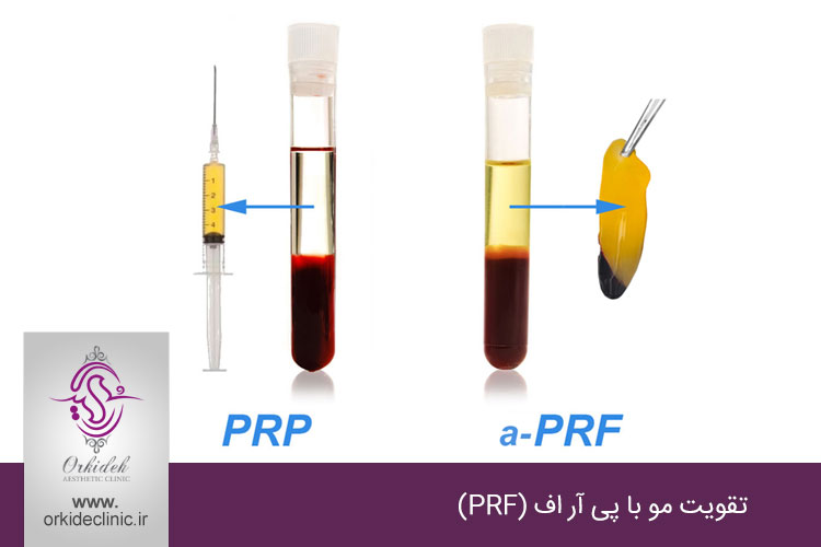 تقویت مو با پی آر اف (PRF)