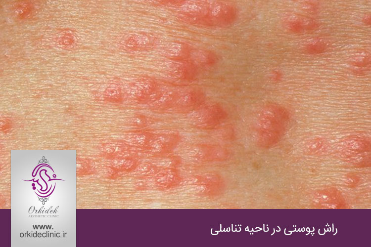 راش پوستی در ناحیه تناسلی