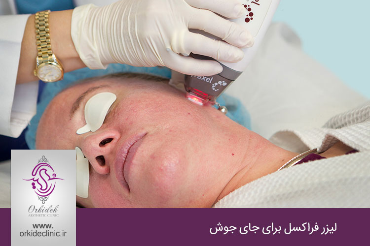 لیزر فراکسل برای جای جوش