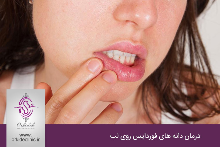 دانه های فوردایس روی لب