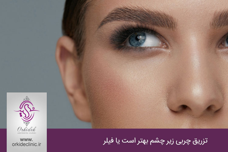 تزریق چربی زیر چشم بهتر است یا فیلر؟