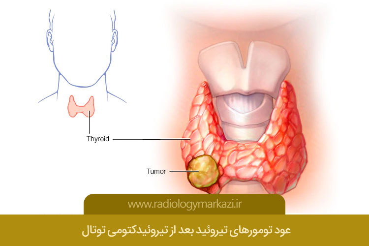 تومورهای تیروئید