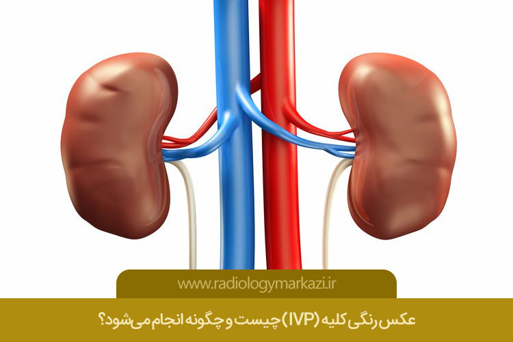 عکس رنگی کلیه (IVP)