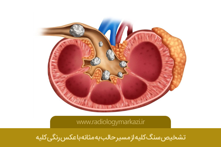 گرافی رنگی کلیه ها