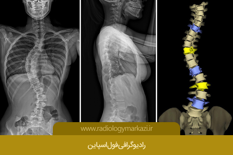 تشخیص انحراف ستون فقرات با رادیوگرافی