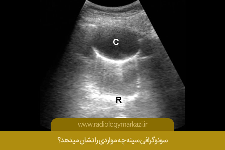 سونوگرافی سینه چه مواردی را نشان میدهد؟