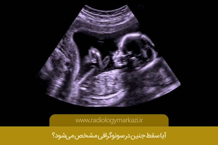 سونوگرافی سقط جنین