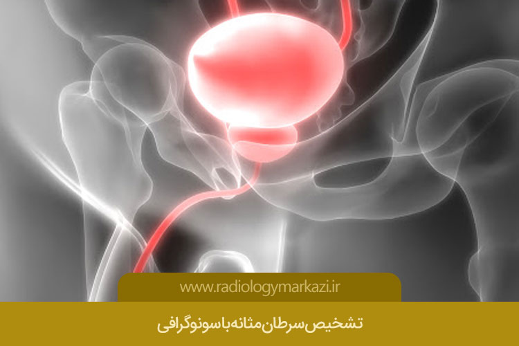 علائم سرطان مثانه