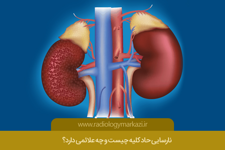 نارسایی حاد کلیه