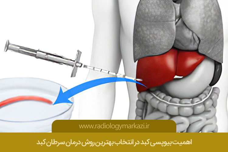 بیوپسی کبد
