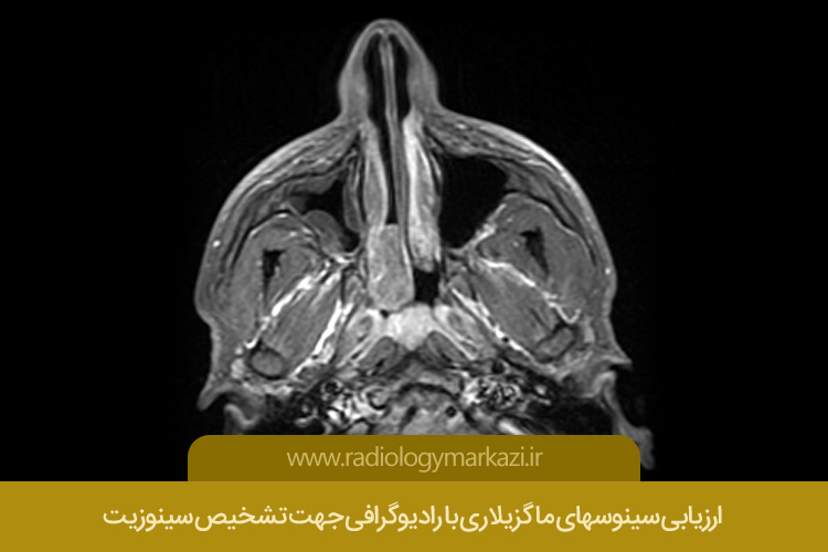 ارزیابی سینوسهای ماگزیلاری با رادیوگرافی جهت تشخیص سینوزیت