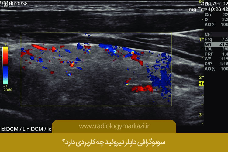 سونوگرافی داپلر تیروئید