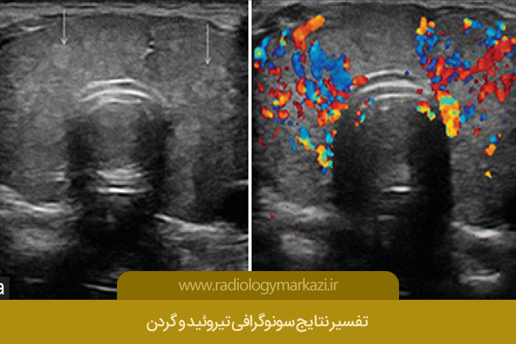 سونوگرافی تیروئید و گردن