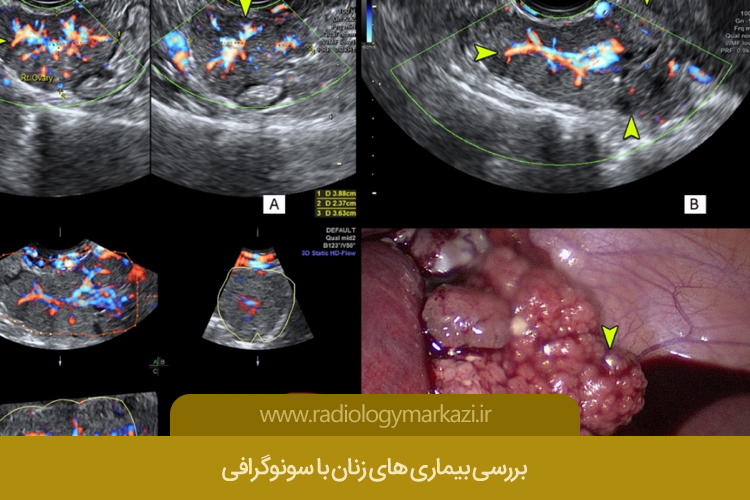 بررسی بیماری های زنان با سونوگرافی