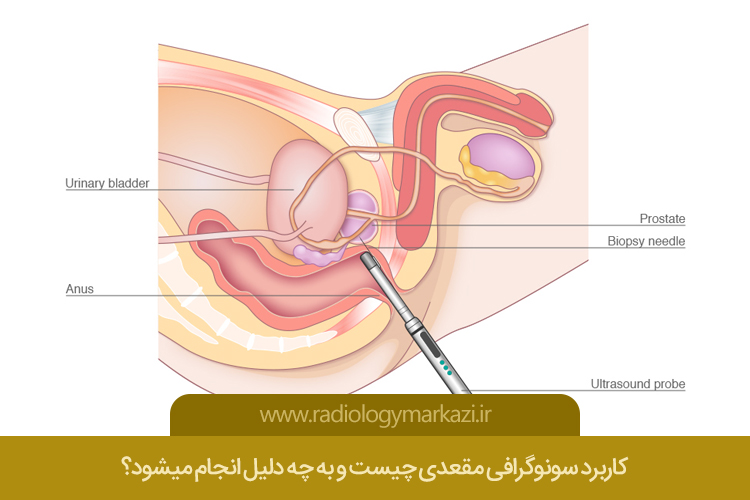 کاربرد سونوگرافی مقعدی