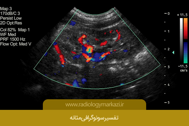 تفسیر سونوگرافی مثانه