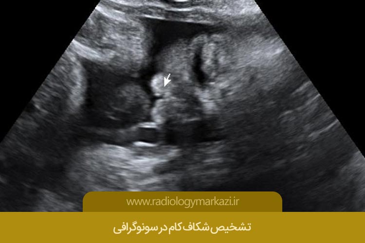 لب شکری در سونوگرافی