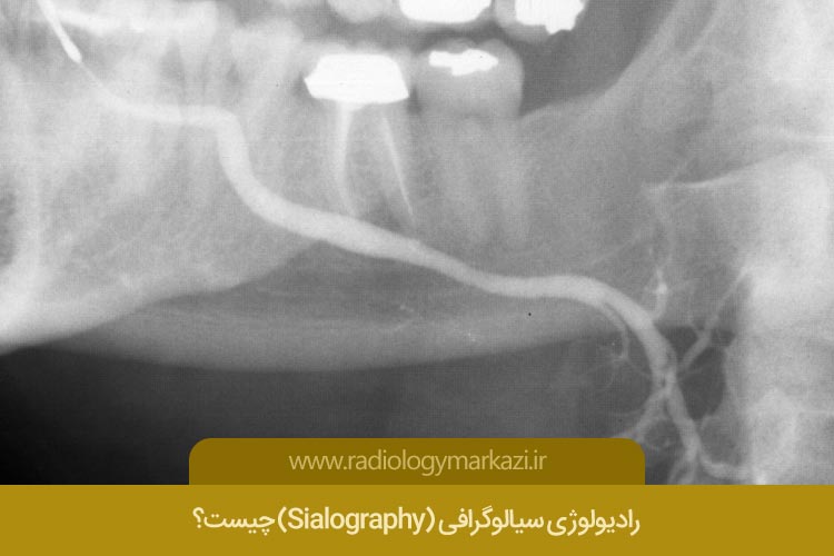 رادیولوژی سیالوگرافی