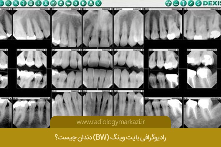 رادیوگرافی بایت وینگ