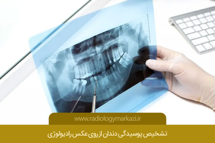 تشخیص پوسیدگی دندان از روی عکس رادیولوژی