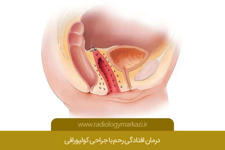 درمان افتادگی رحم