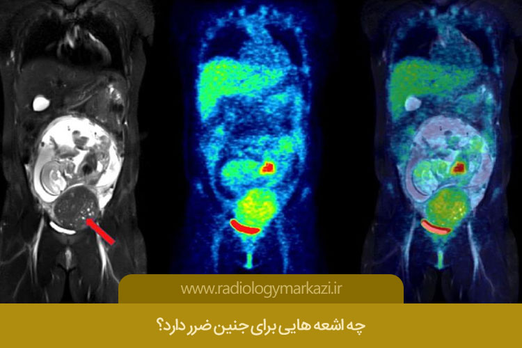 جنین و اشعه عکس برداری