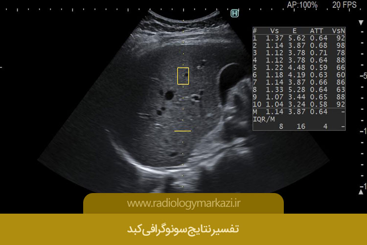 تفسیر نتایج سونوگرافی کبد