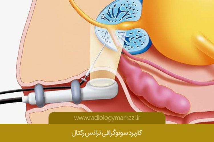 کاربرد سونوگرافی ترانس رکتال