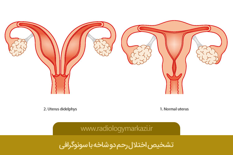 تشخیص اختلال رحم دو شاخه با سونوگرافی