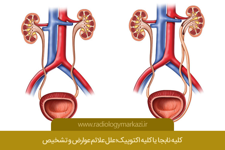 کلیه نابجا یا کلیه اکتوپیک