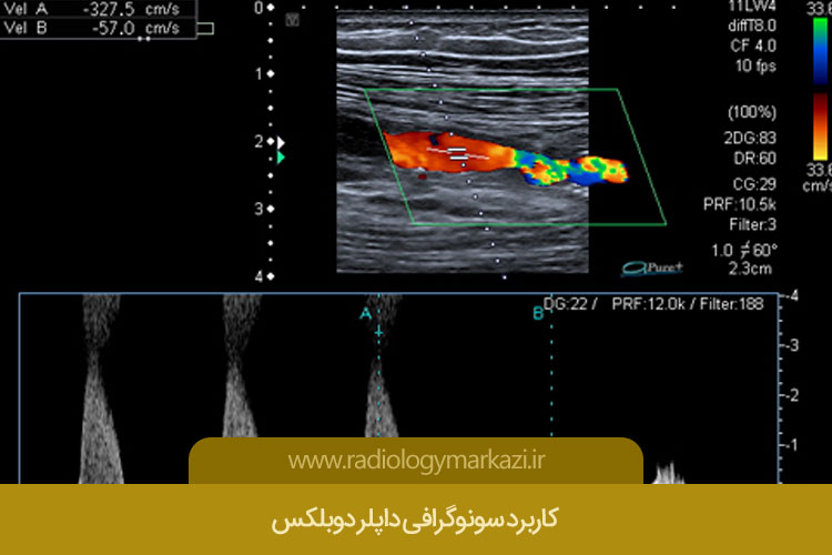 کاربرد سونوگرافی داپلر دوبلکس