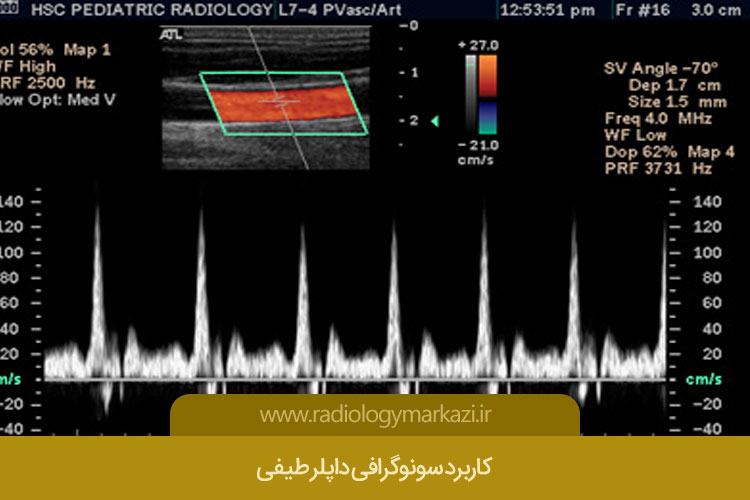 سونوگرافی داپلر طیفی