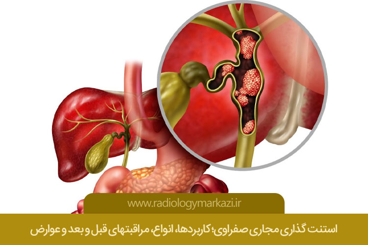 استنت گذاری مجاری صفراوی