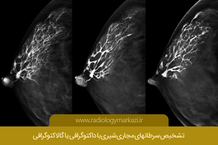 تشخیص سرطانهای مجاری شیری با داکتوگرافی یا گالاکتوگرافی