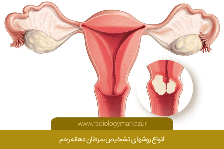 انواع روشهای تشخیص سرطان دهانه رحم