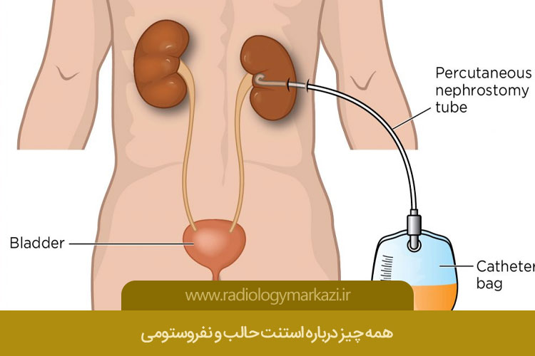 استنت حالب و نفروستومی