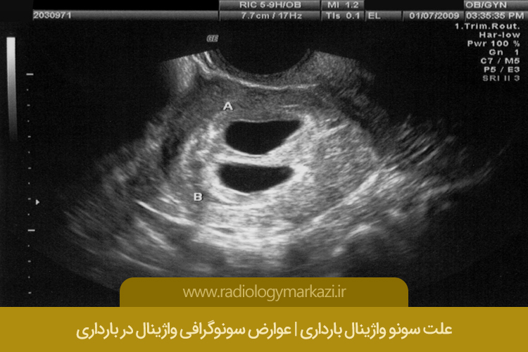 علت سونوگرافی واژینال بارداری 