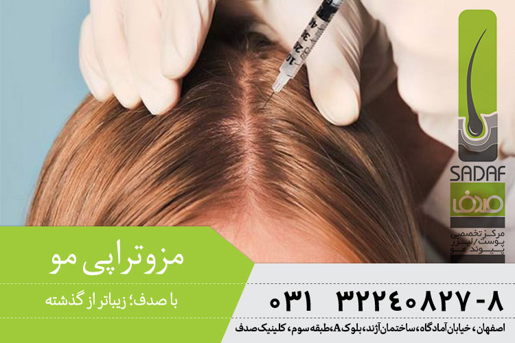 بهترین مزوتراپی مو در اصفهان