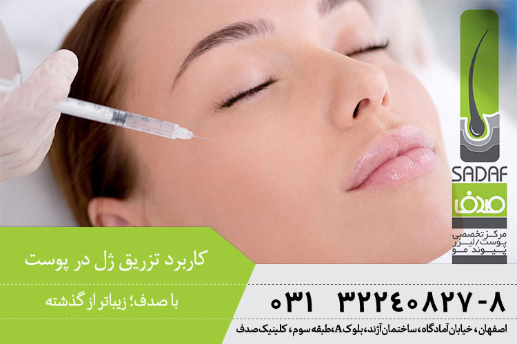 بهترین تزریق ژل در اصفهان