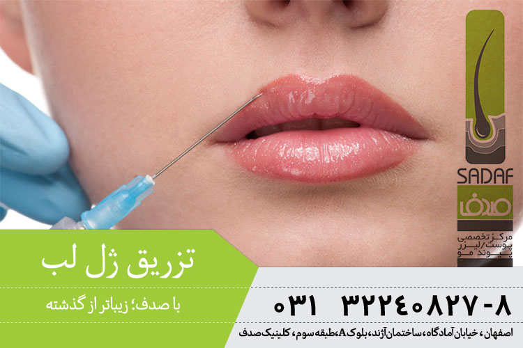 بهترین تزریق ژل لب در اصفهان