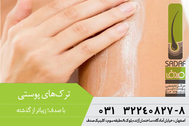 درمان ترک‌های پوستی در اصفهان