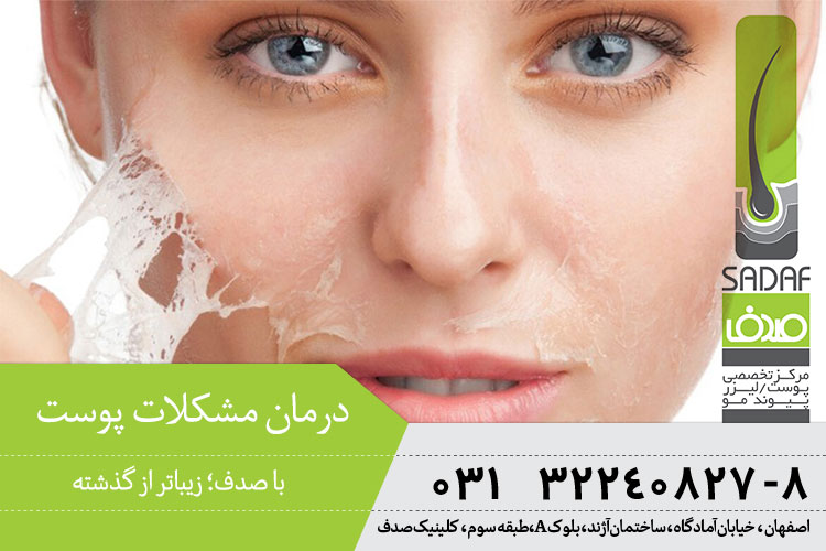 درمان مشکلات پوست در اصفهان