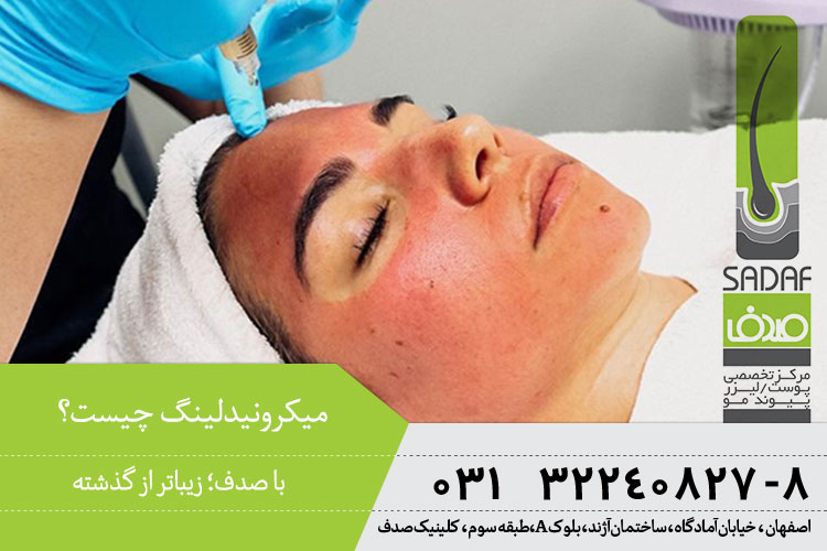 میکرونیدلینگ در اصفهان