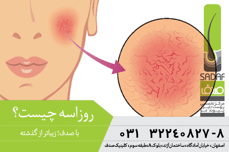 درمان روزاسه در اصفهان