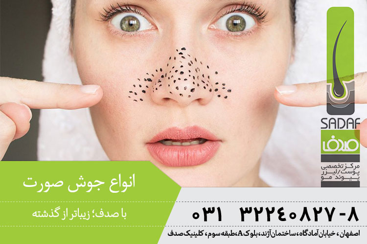 درمان جوش صورت در اصفهان