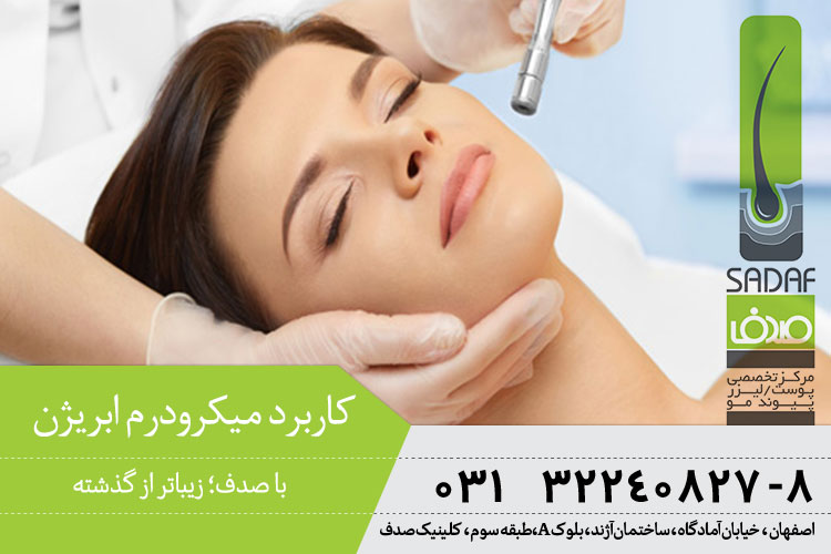 میکرودرم ابریژن در اصفهان