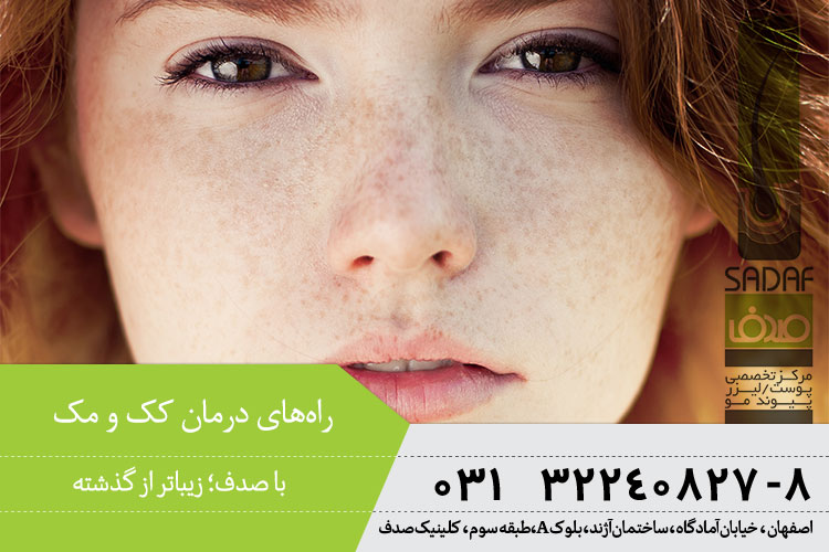 بهترین درمان کک و مک در اصفهان